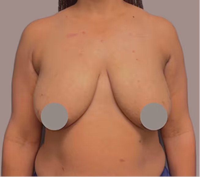Before breast surgery