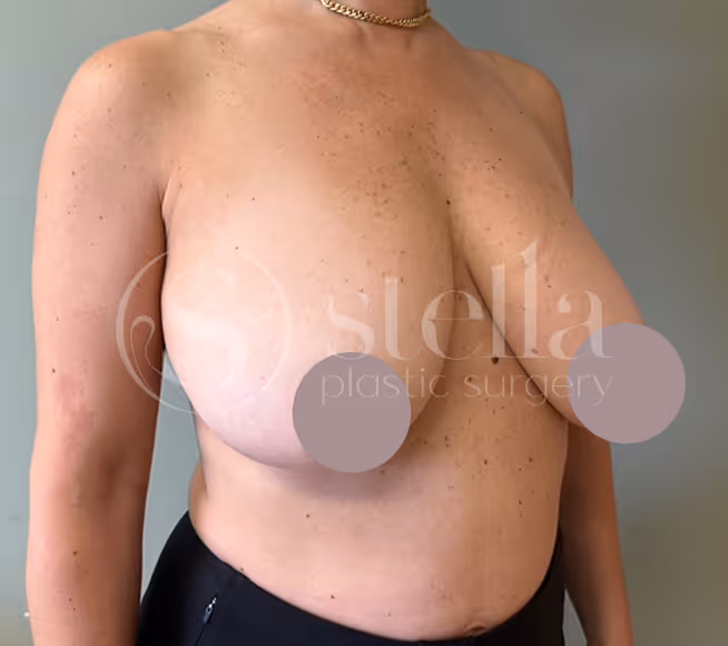 Before Breast Reduction at Stella Plastic Surgery