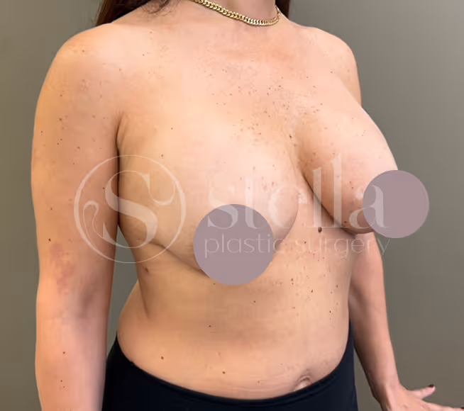 After Breast Reduction at Stella Plastic Surgery