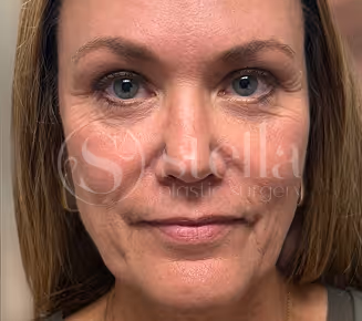 Patient after treatment at Stella Plastic Surgery