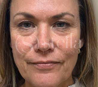 Patient before treatment at Stella Plastic Surgery