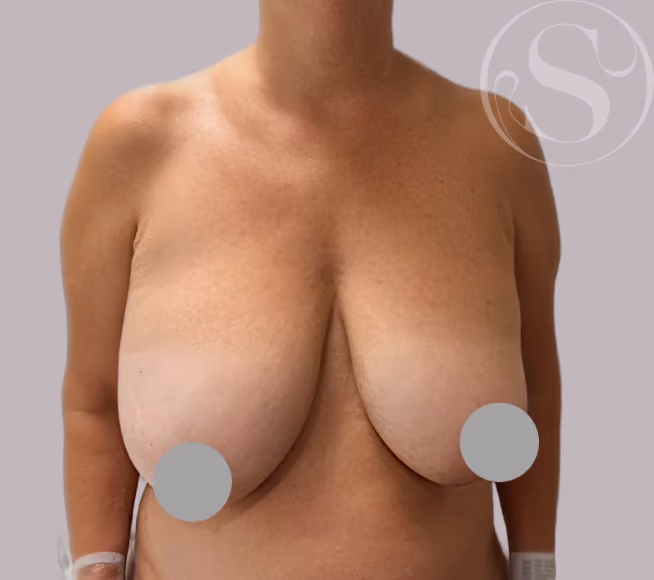 Before breast lift surgery at Stella Plastic Surgery