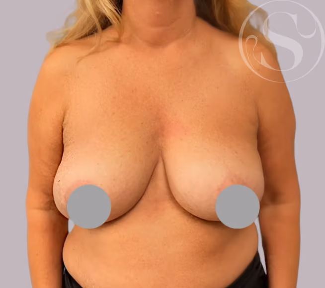After breast lift surgery at Stella Plastic Surgery