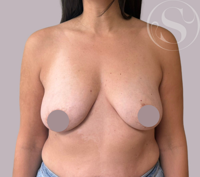 Before breast reconstruction surgery at Stella Plastic Surgery
