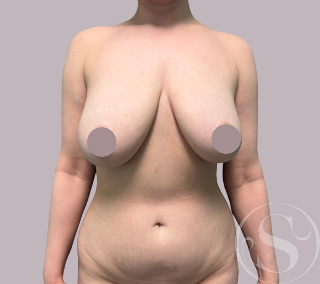 Before liposuction at Stella Plastic Surgery
