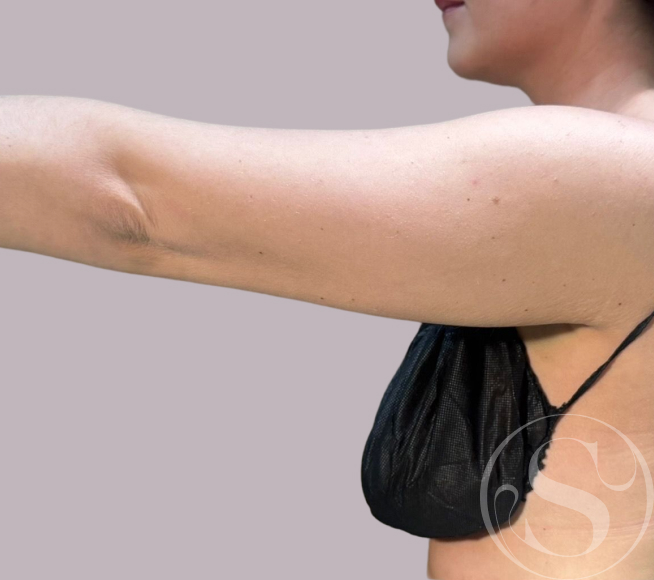 Before arm lift at Stella Plastic Surgery