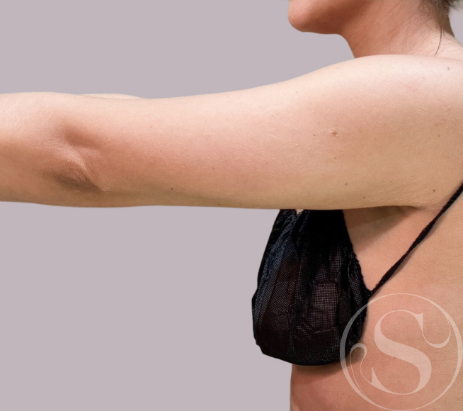 After arm lift at Stella Plastic Surgery