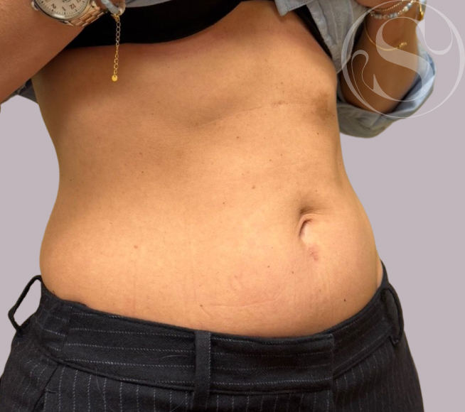 After Morpheus8 treatment at Stella Plastic Surgery