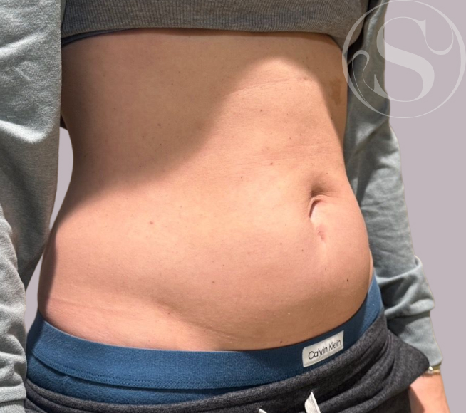 Before Morpheus8 treatment at Stella Plastic Surgery