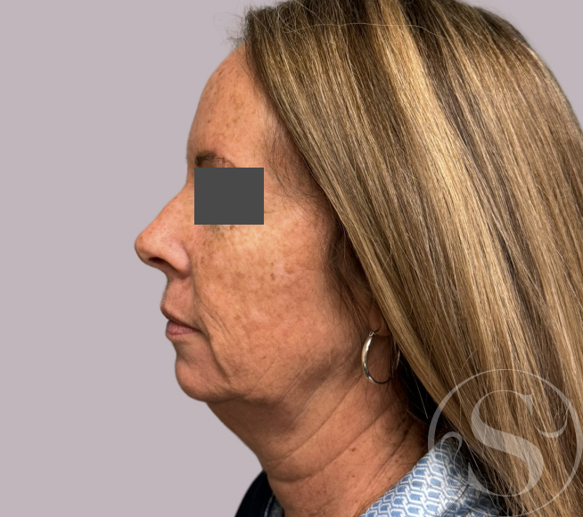 Before face lift at Stella Plastic Surgery