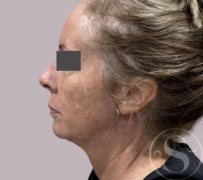 After face lift at Stella Plastic Surgery