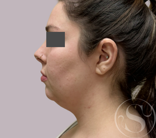 Before neck lift at Stella Plastic Surgery
