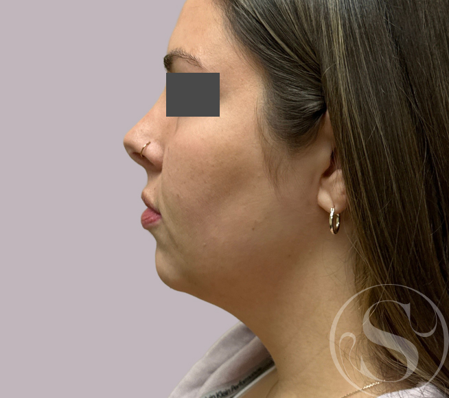 After neck lift at Stella Plastic Surgery