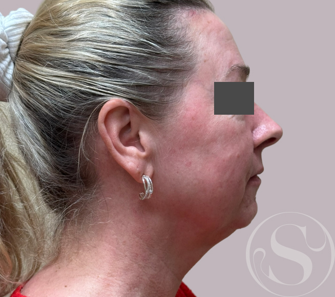 Before dermal fillers at Stella Plastic Surgery