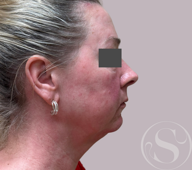 After dermal fillers at Stella Plastic Surgery