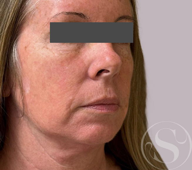 Before facial filler at Stella Plastic Surgery