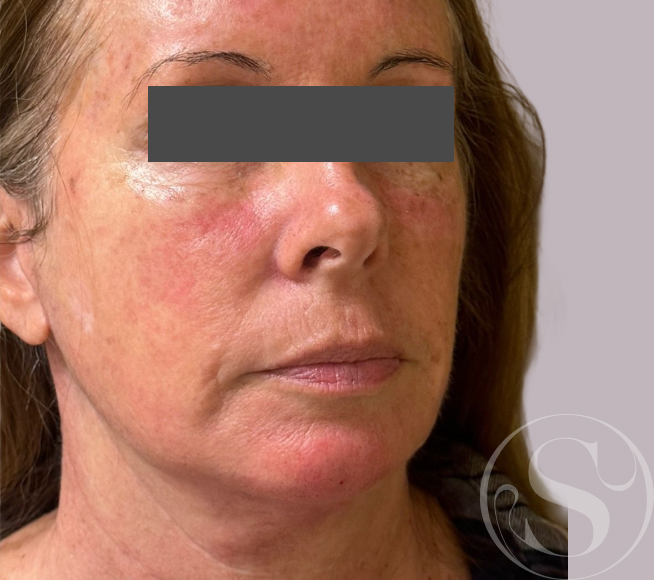 After facial filler at Stella Plastic Surgery
