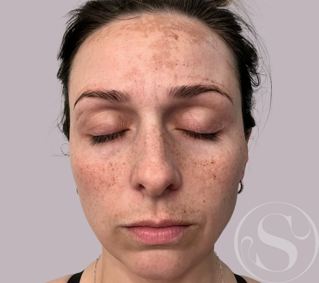 Before IPL treatment at Stella Plastic Surgery