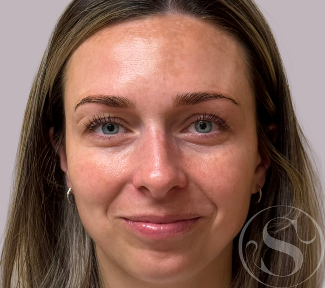 After IPL treatment at Stella Plastic Surgery