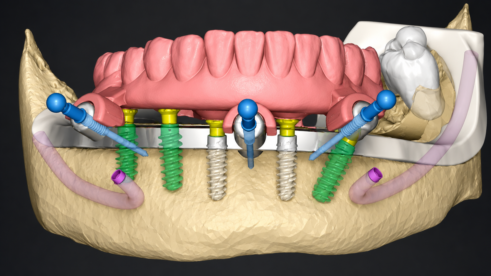Digital Implant Planning 3