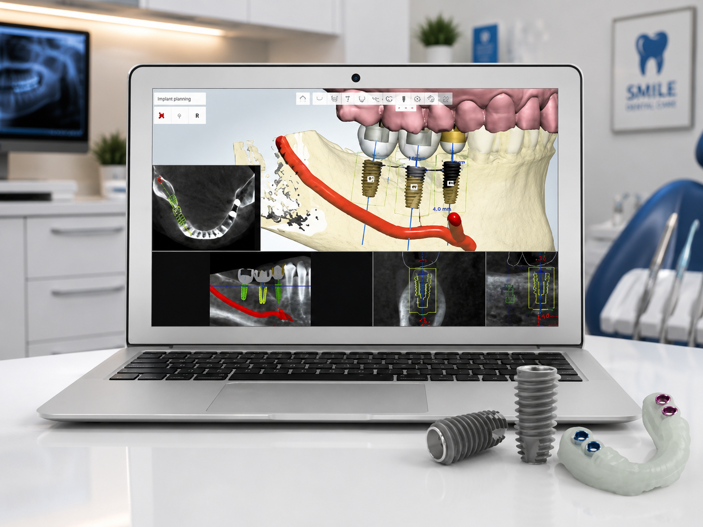 Digital Implant Planning 2
