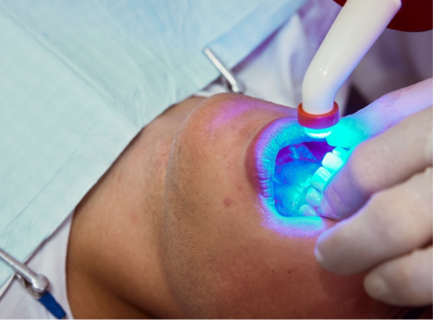 The Truth About Teeth Whitening
