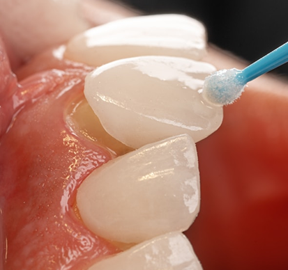 Veneers