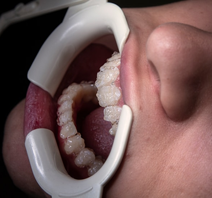 Teeth Whitening