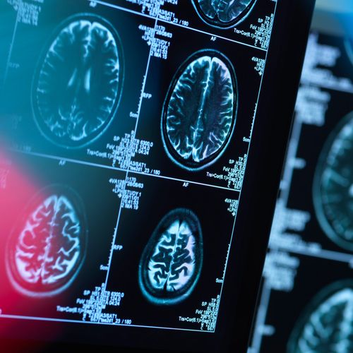 NeuroLite® Tc-99m Bicisate | Neurologic Perfusion SPECT Imaging | SHINE