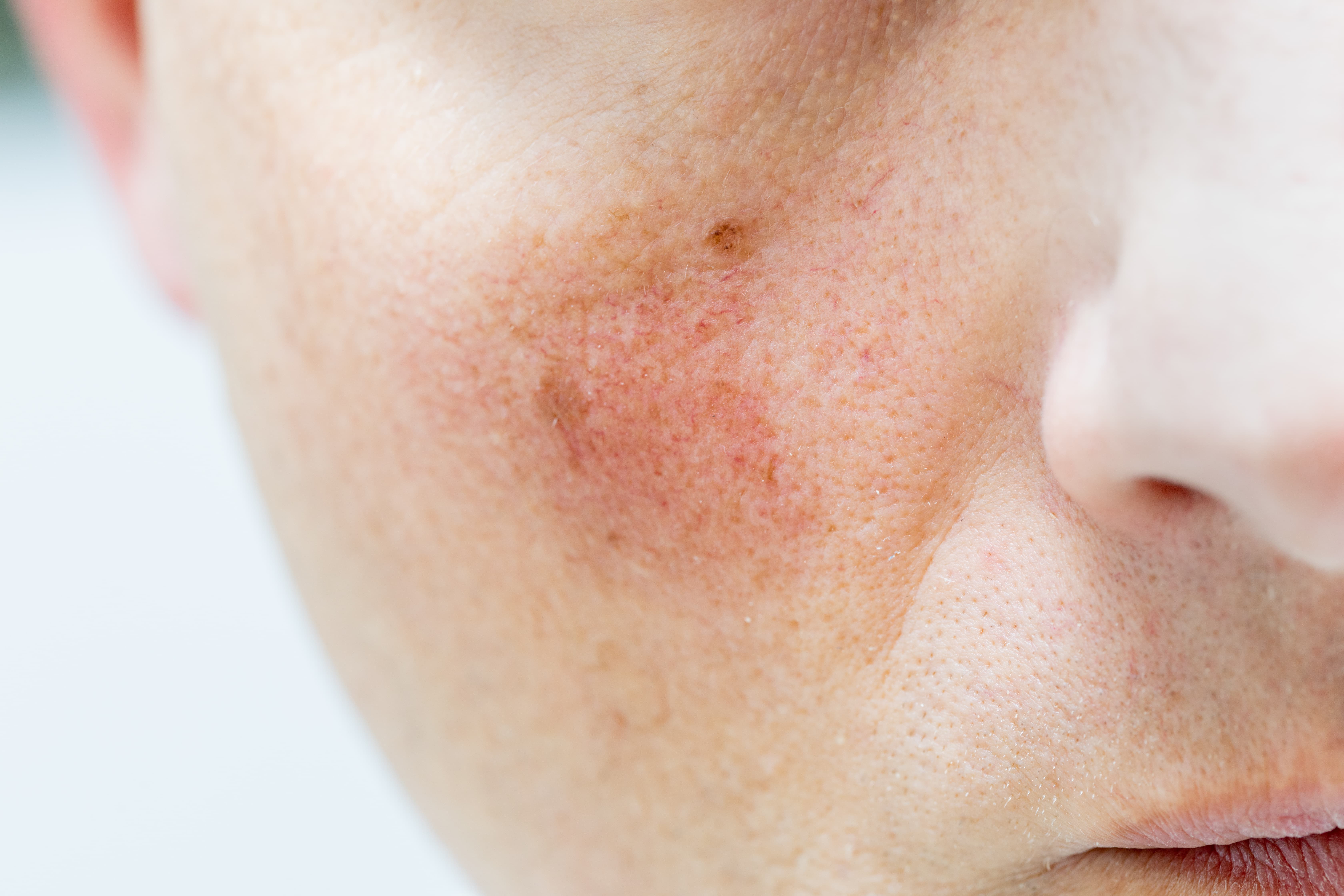 Rosacea Treatments
