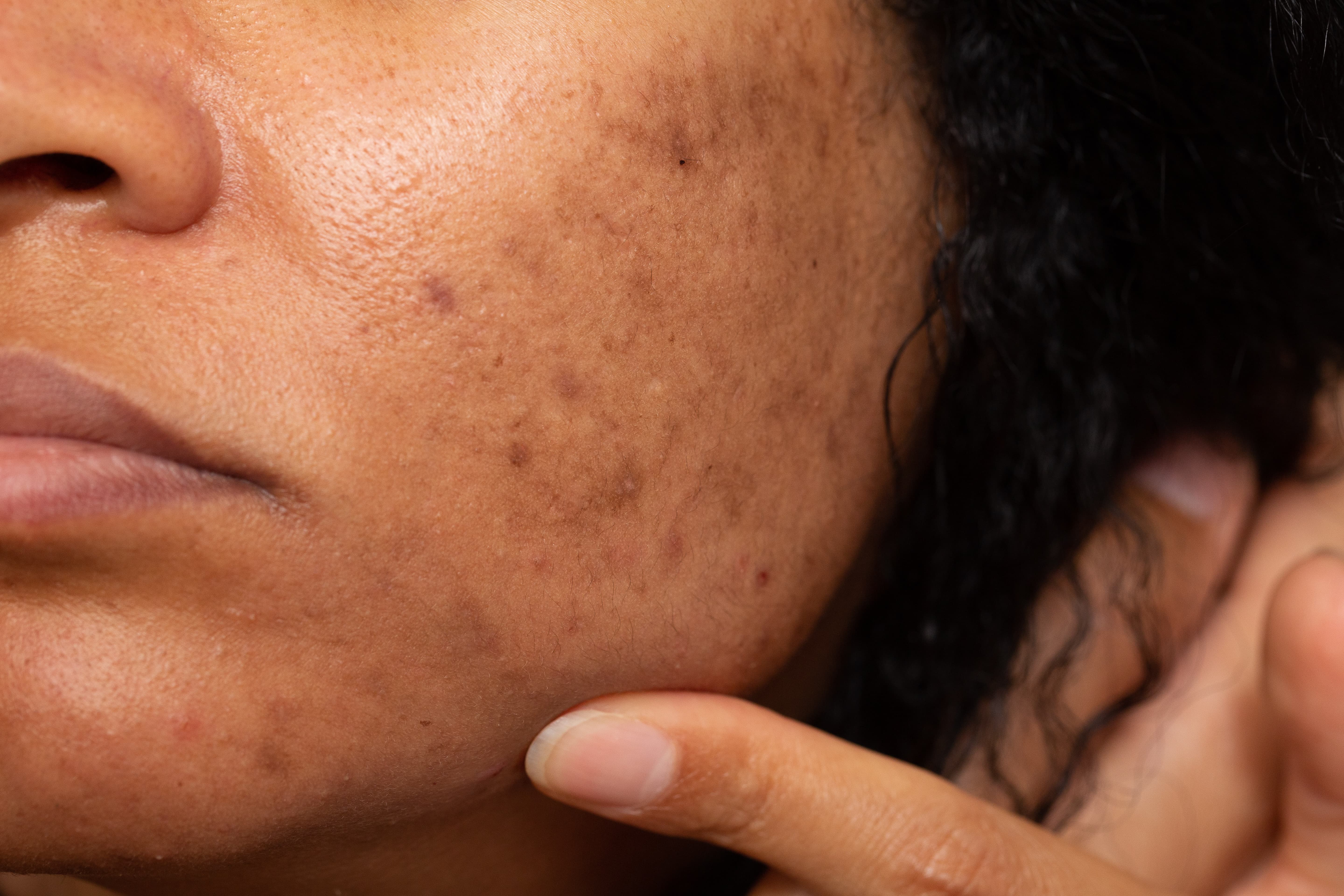 Pigmentation Treatments