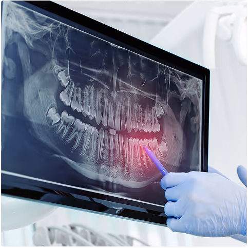 Dental X-ray on screen showing teeth and jaw with a gloved hand pointing at a highlighted area.