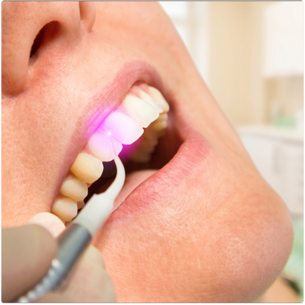 Close-up of dental laser treatment being applied to the upper front teeth.