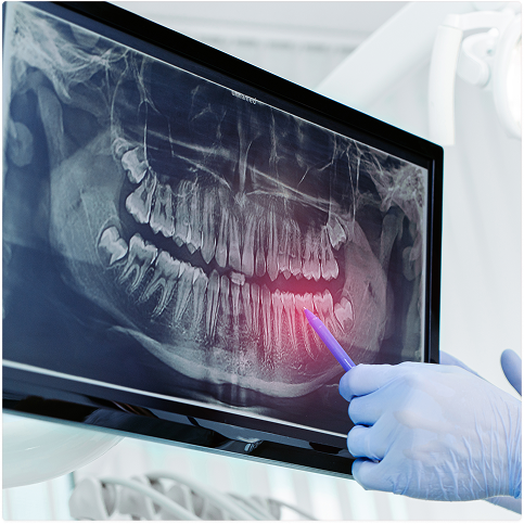 X-ray image of teeth with a gloved hand pointing at a highlighted area in the lower jaw.