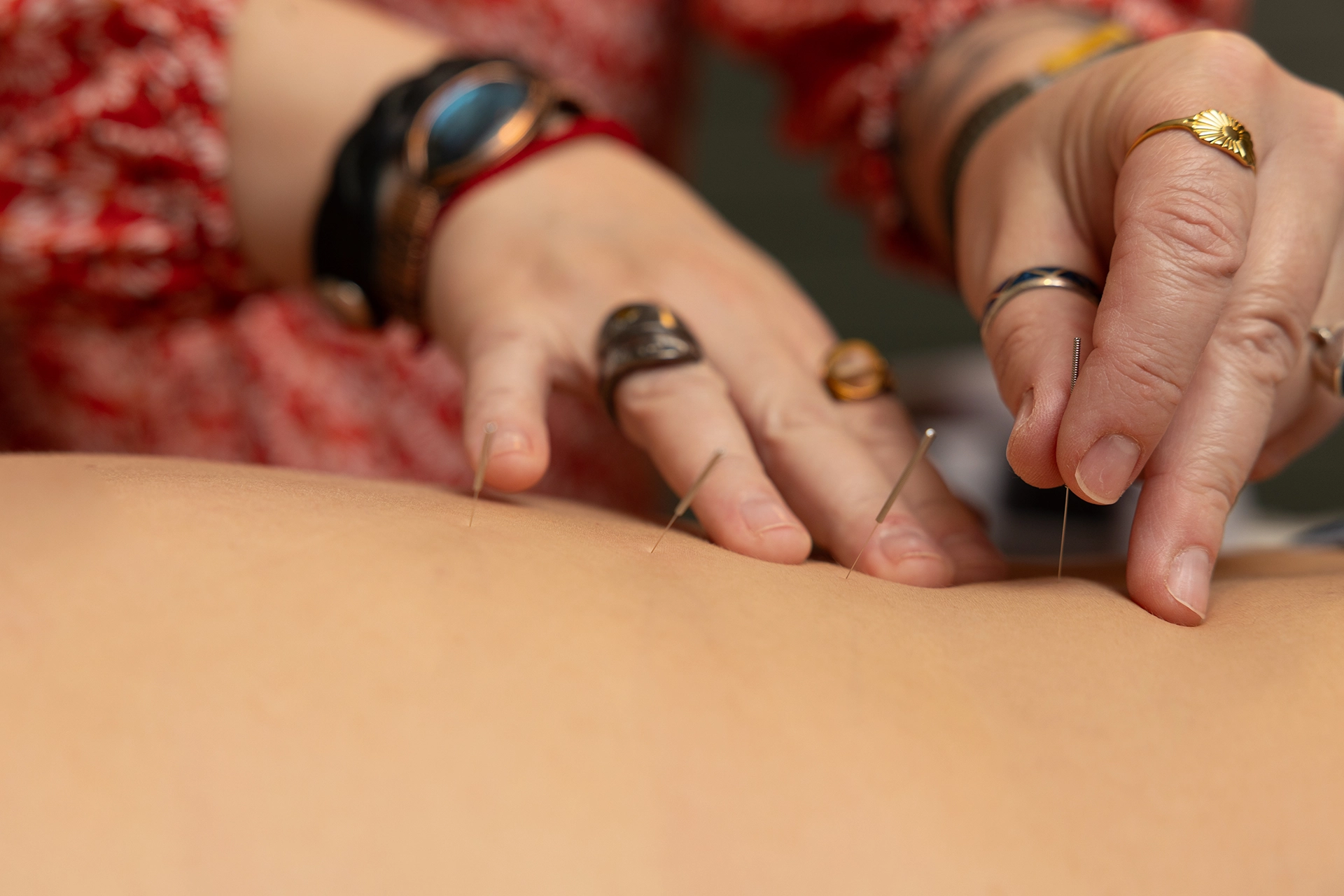 Close-up of Jennah performing acupuncture, inserting thin needles into skin on a person's back, with the practitioner wearing several rings and a watch.