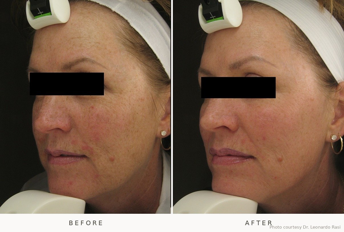 IPL Photofacial before and after at Lé Spa Medical Spa Beaverton