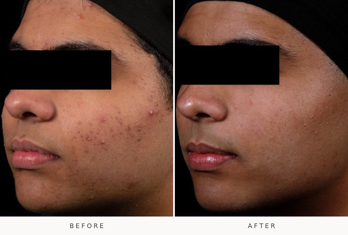 AviClear acne laser before and after at Lé Spa Medical Spa Beaverton