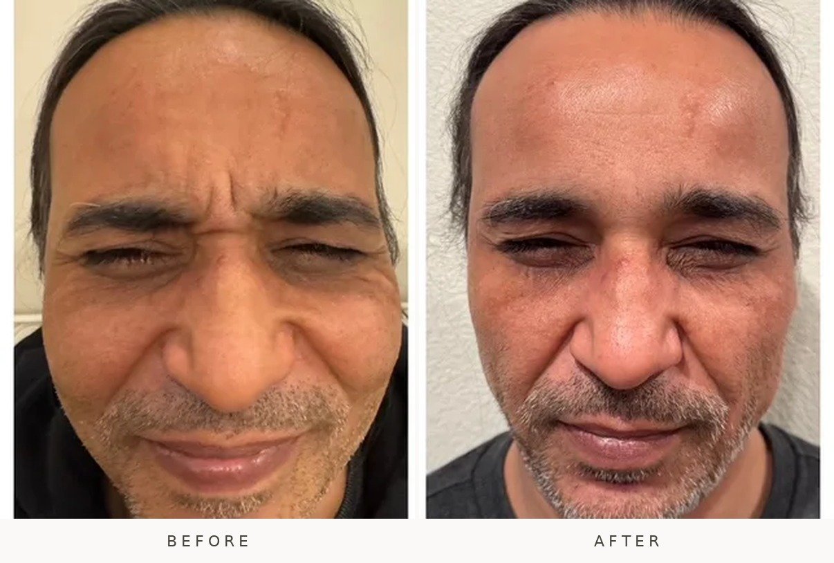 Botox results by Elana Scharff NP at Lé Spa Medical Spa Beaverton