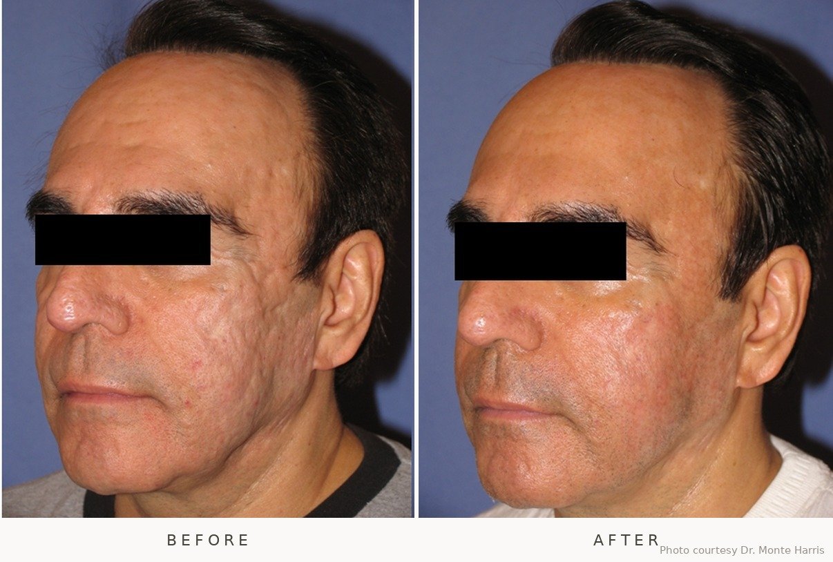 RF Microneedling / Laser Genesis before and after at Lé Spa Medical Spa