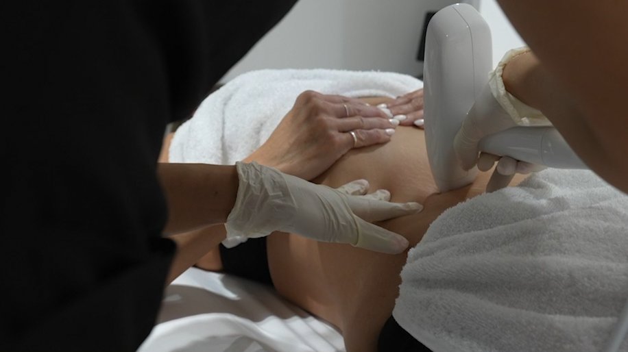 RF Microneedling