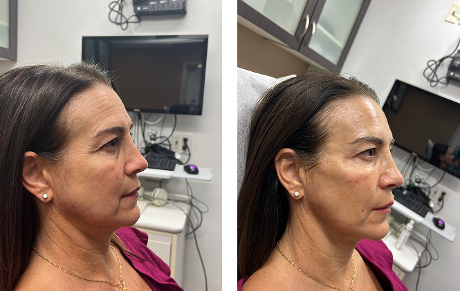 Side-by-side profile photos of a middle-aged woman in a medical or cosmetic clinic, showing her face and neck before and after a treatment.