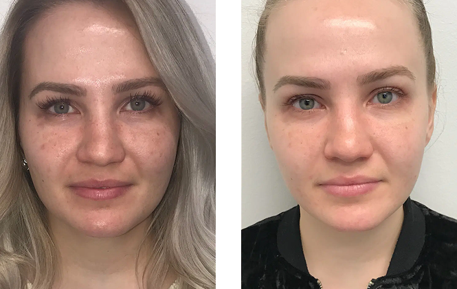 Side-by-side portrait photos of a woman showing before and after skin treatment, with visible freckles and uneven skin tone on the left and clearer, smoother complexion on the right.