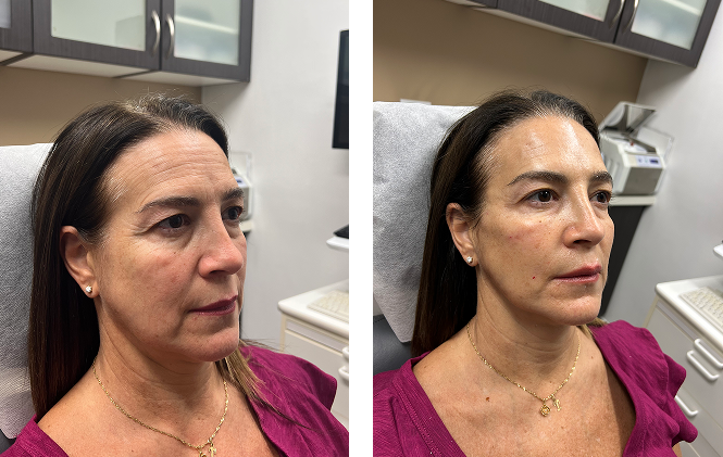 Side-by-side comparison of a woman with longer brown hair, wearing a pink top and a gold necklace, seated in a medical office before and after a cosmetic facial treatment.