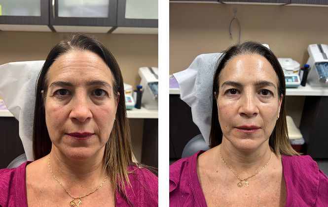 Side-by-side before and after images of a woman in a medical or cosmetic setting, showing subtle changes in her facial appearance.