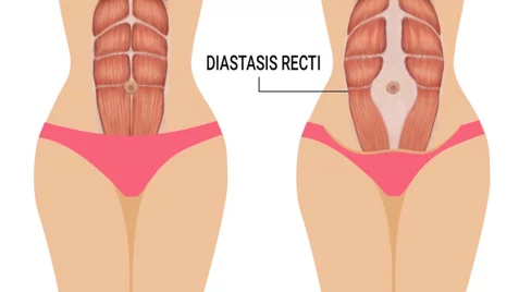 Diagram showing normal abdominal muscles on left and diastasis recti with separated muscles on right.