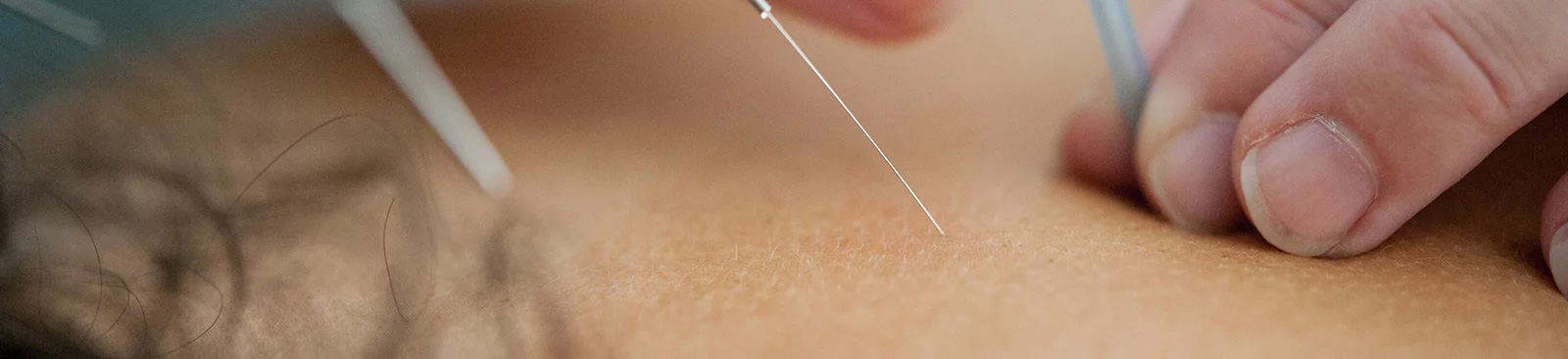 Close-up of a hand inserting a thin acupuncture needle into skin.