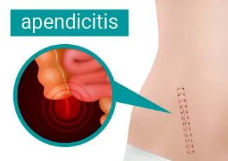 Upala slepog creva (apendicitis)