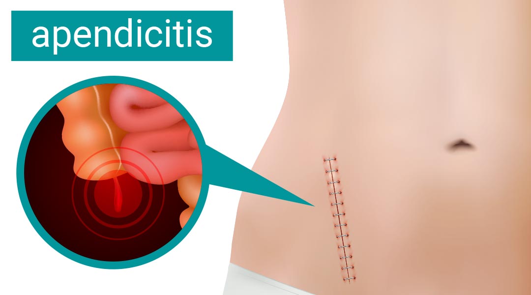 Apendicitis je upala slepog creva – saznajte koji su simptomi, uzroci, kako se dijagnostikuje i leči ovo hitno medicinsko stanje.