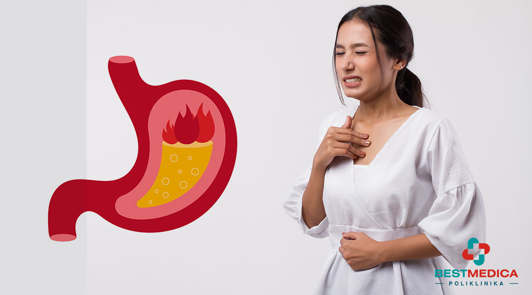 Gorušica nastaje vraćanjem kiselog želudačnog sadržaja u jednjak – saznajte uzroke, simptome i kako sprečiti i lečiti gorušicu.