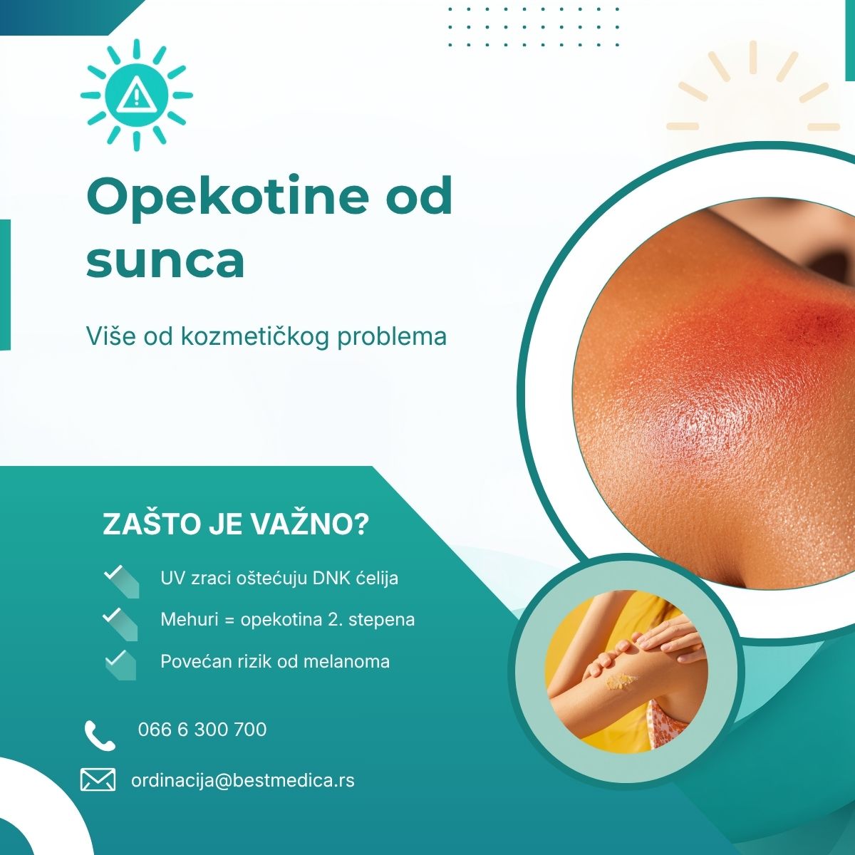"Malo ću se ispeći, pa ću se lepšepreplanuti." Ova rečenica čuje se svako leto — i svako leto se neko požalina posledice.